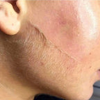Exquisite Laser Clinic  Health & Beauty Dermaplaning Facial