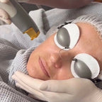Exquisite Laser Clinic  skin treatment Laser Genesis Skin Rejuvenation Full Face